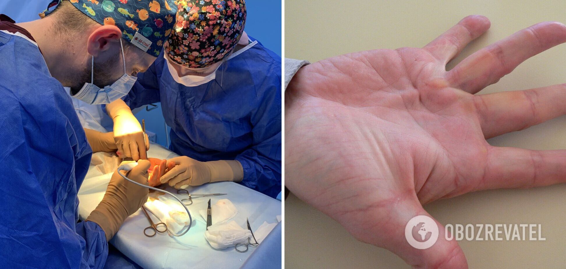 Багато хто звертається занадто пізно: лікар розповів про небезпечну хворобу – руки стають як у 'Людини-павука'